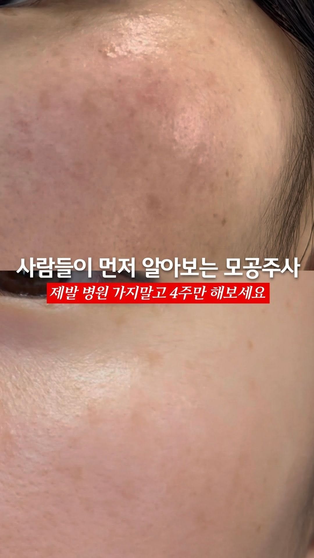 egmz86 게시물 이미지: 마흔 넘고 평생 처음만나는 망가진 피부를 보았어요

나이 드니까 한번 커지고...