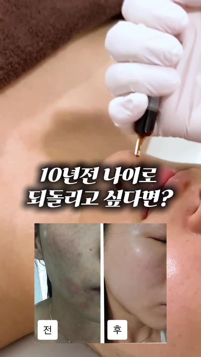 esthetia_songdo_sh 게시물 이미지: 주름 지우개 ’레틴알데히드‘를 아시나요?

어려보이고 싶은 욕심은 누구나 다...
