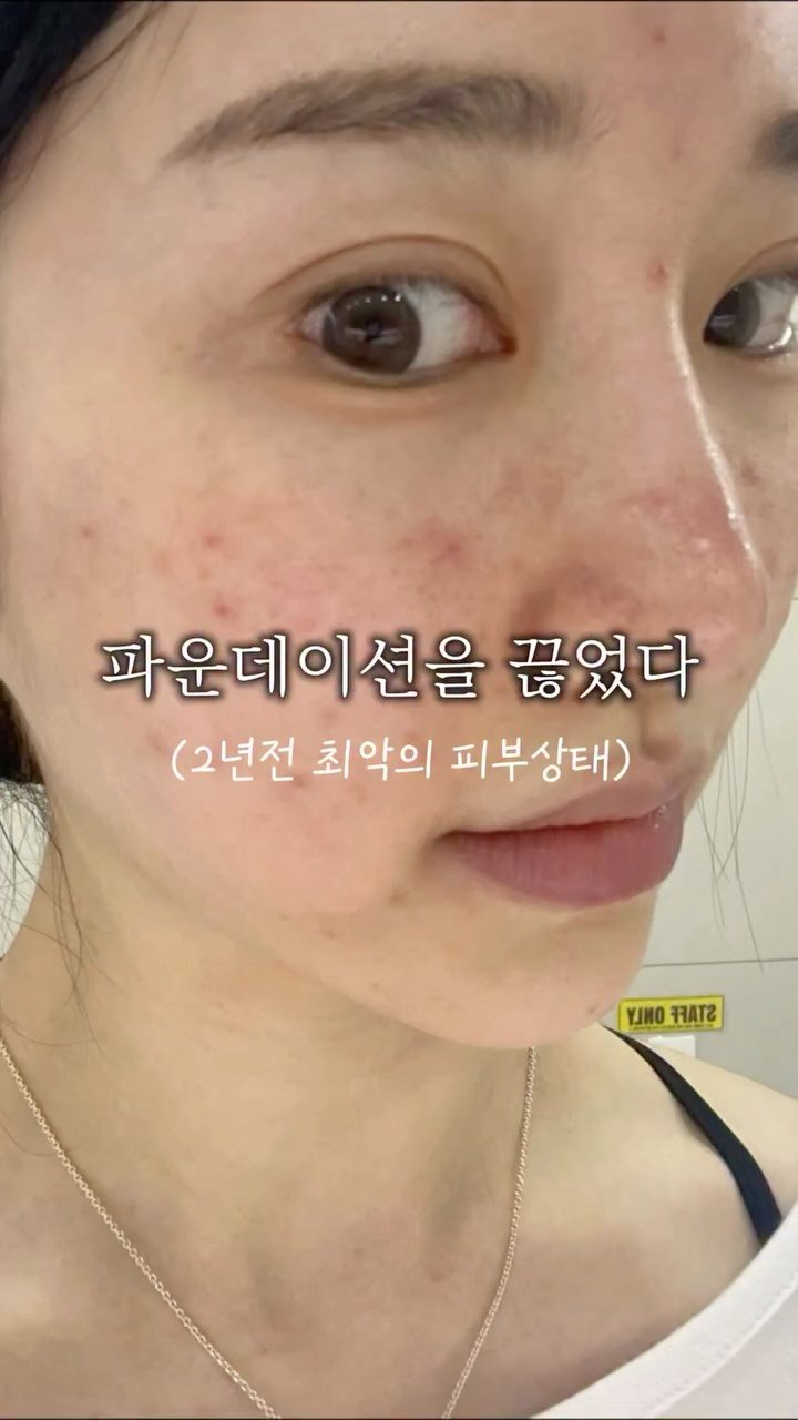 eternalskin__ 게시물 이미지: 피부과에 쓴돈만 수천만원
좋다는 레이저 받으면 좋아질줄 알았어요

레이저로 이미...