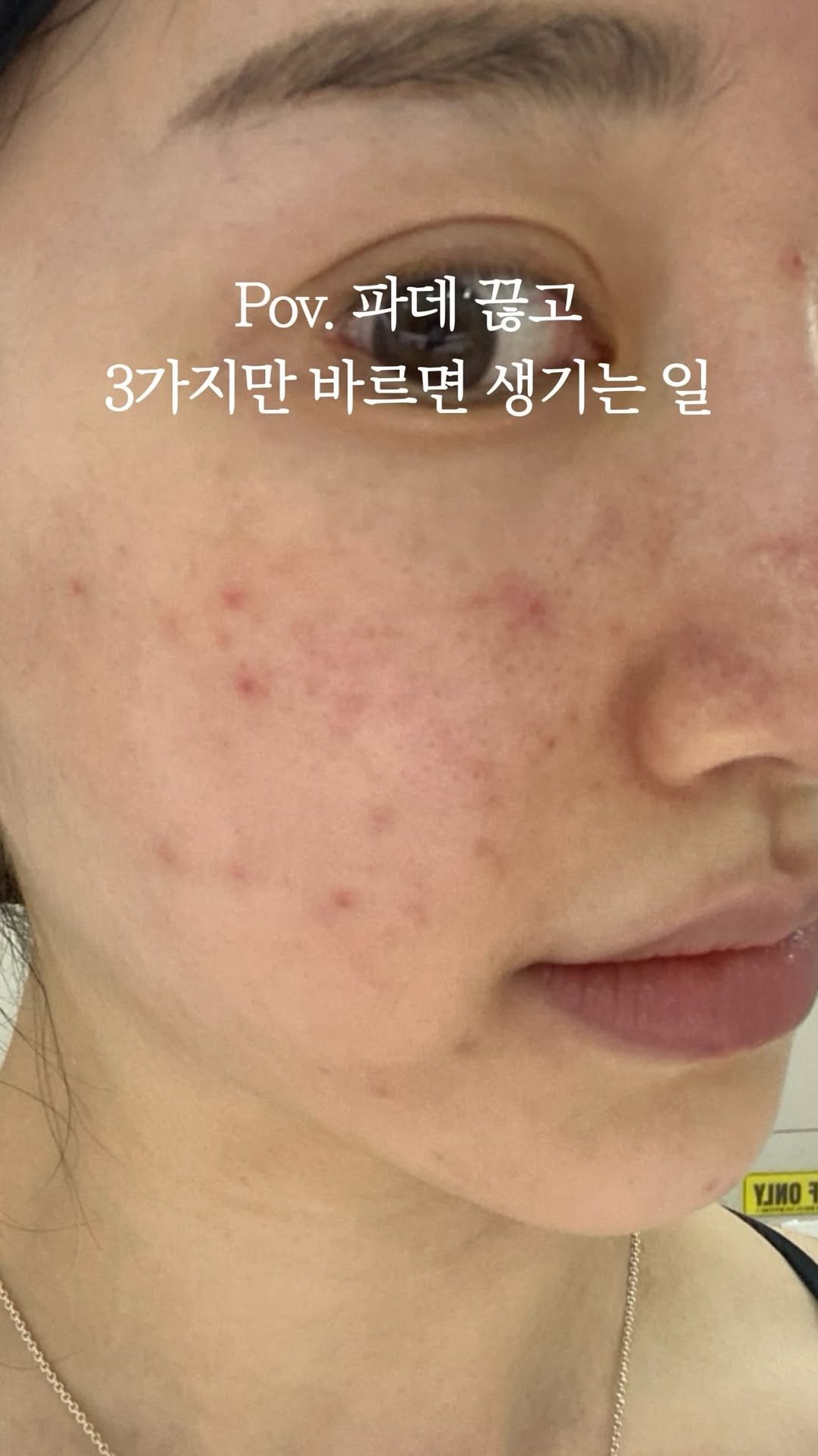 eternalskin__ 게시물 이미지: 피부과에 쓴돈만 수천만원
여드름 레이저 받으면 좋아질줄 알았어요

근데 레이저로...