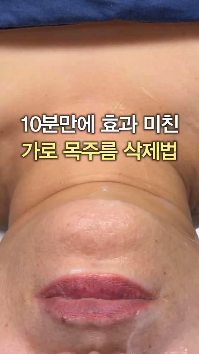 eternalskin__ 게시물 이미지: 여러분, 내 목에 늘어난 주름살이
“꽉 막힌 순환“ 때문일 수 있다는 거...