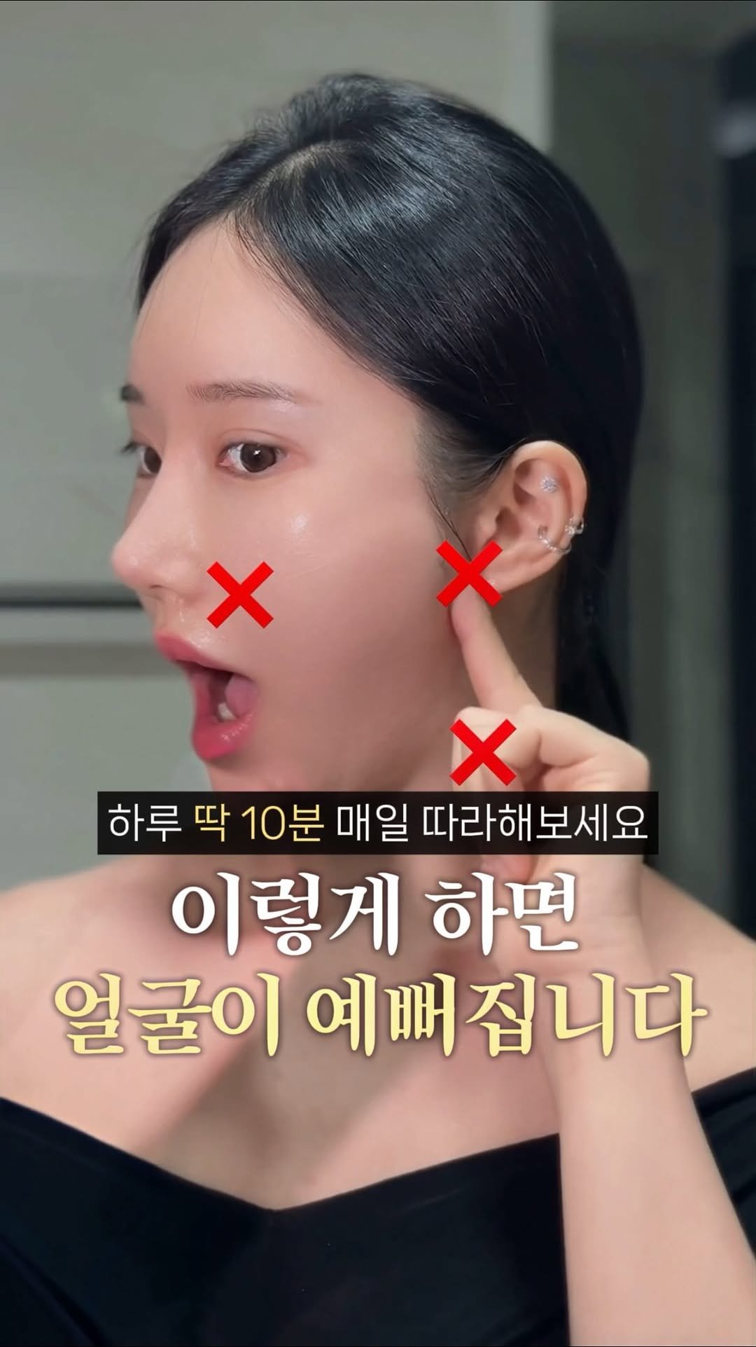 eternalskin__ 게시물 이미지: 옆광대는 커지고 계속 길어지는 중안부🤥
푹푹 꺼지는 팔자주름이 고민이라 필러나 윤곽...
