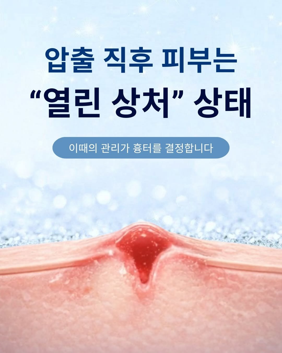 Photo by 부산 여드름전문 이터널스킨 대표원장 | 엄지현 on December 21, 2025. May be an image of poster, book and text that says '압출 직후 피부는 "열린 상처" 상태 이때의 관리가 흉터를 결정합니다'.