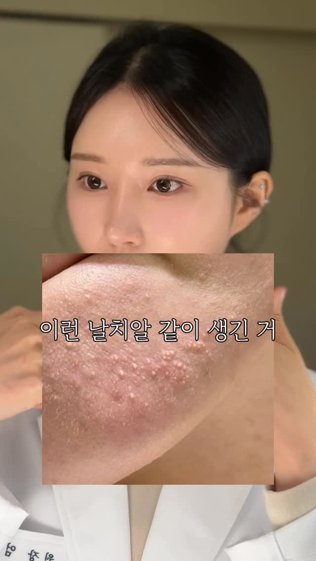 eternalskin__ 게시물 이미지: ❌ 일반인들은 절대 구분 못하는❌
모낭염 VS 여드름

여드름인 줄 알고 짰는데 다...
