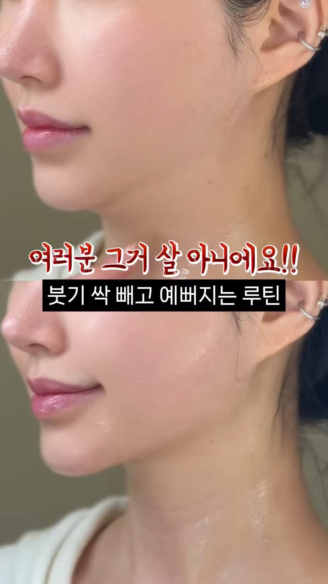 eternalskin__ 게시물 이미지: 📌디바이스 정보는
5,000개의 에스테틱 빅테이터로 완성된
“슈퍼젝션 디바이스”...