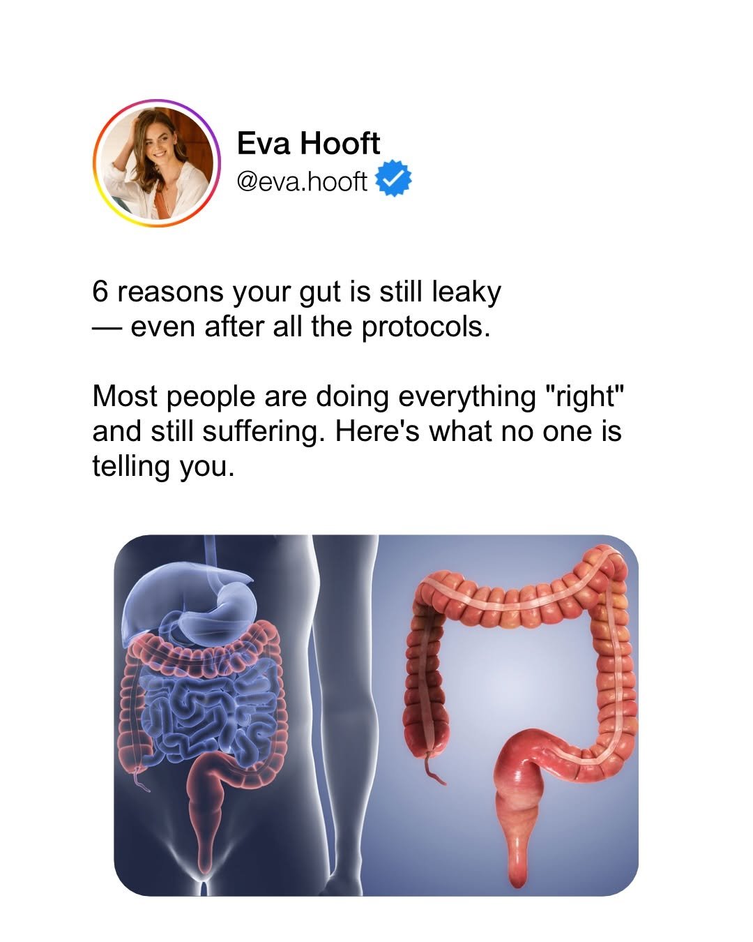 Photo by Eva Hooft | Somatic and Detox Coach on March 29, 2026. May be an image of worm and text that says 'Eva Hooft @eva.hooft 6 reasons your gut is still leaky -ever even after all the protocols. Most people are doing everything "right" and still suffering. Here's what no one is telling you.'.
