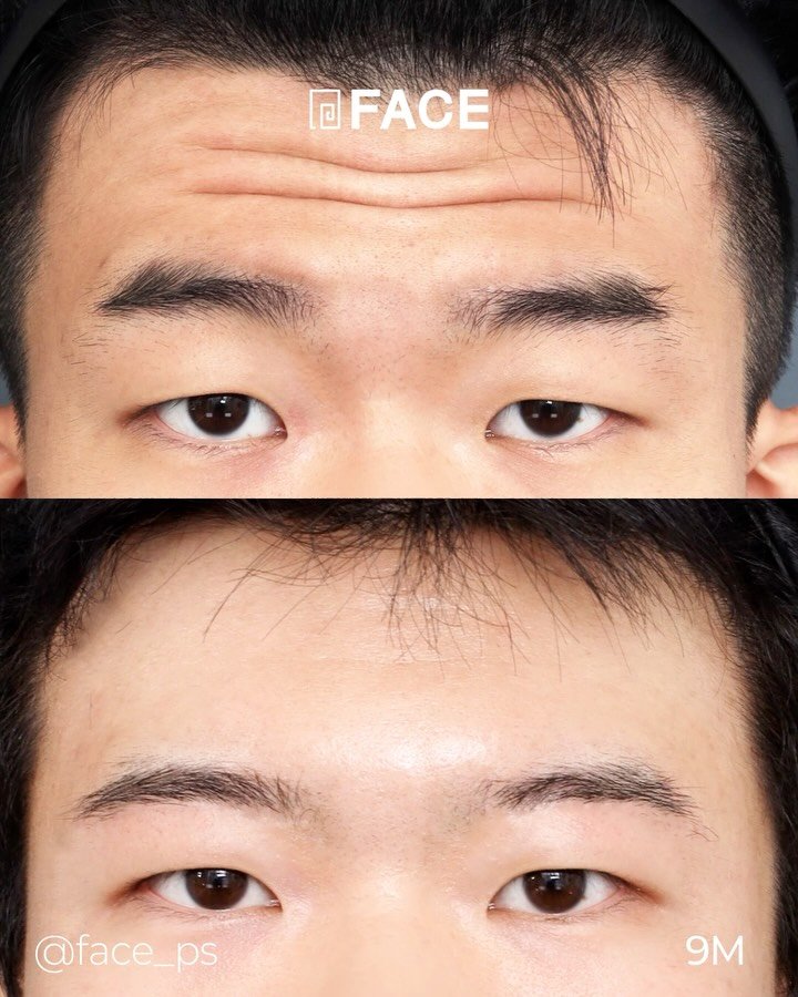 face_ps 게시물 이미지: 이미주름이 고민이시라고요?

눈을 뜨기만 해도 생기는 이마주름, 젊은 나이의...