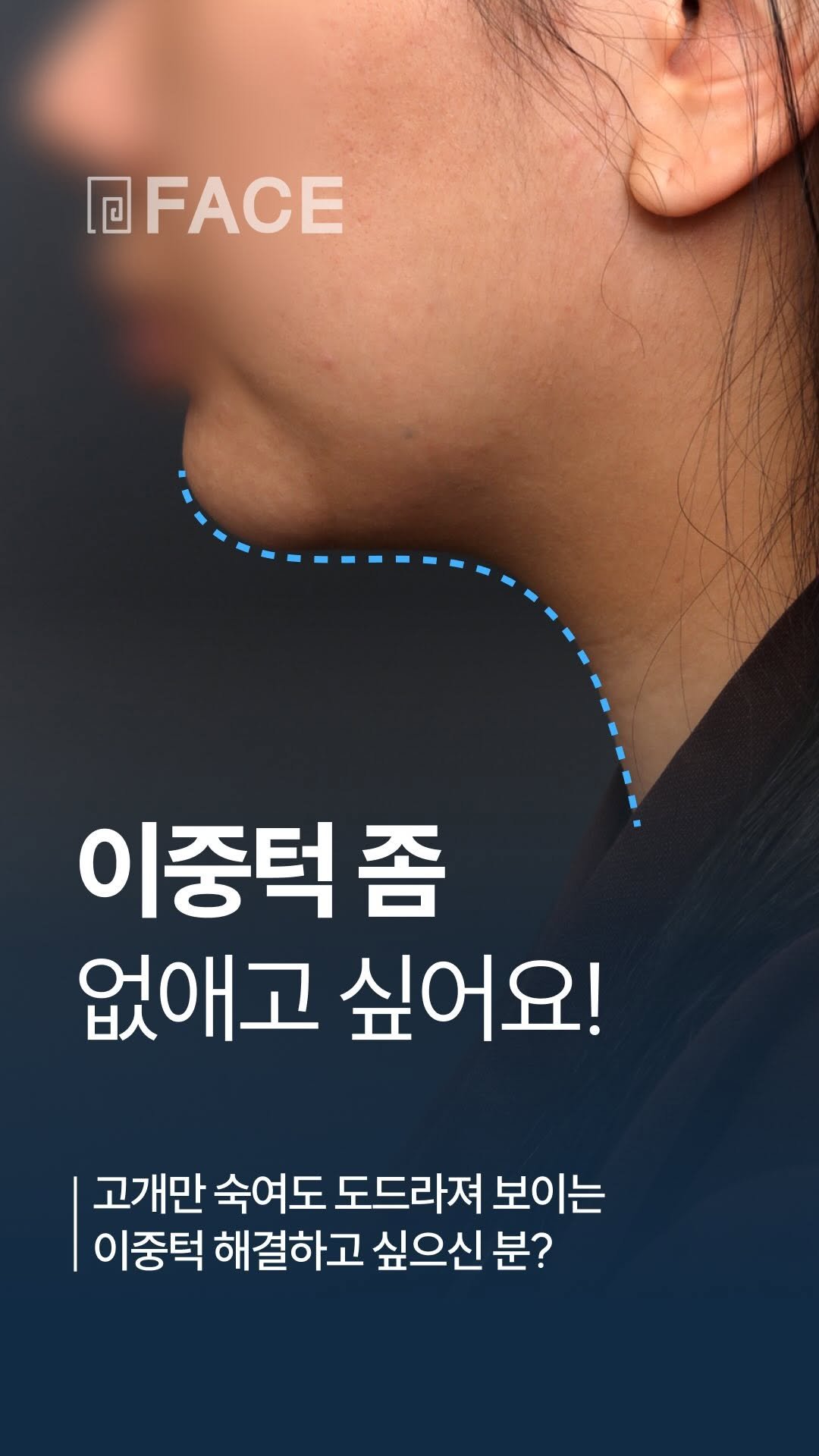 face_ps 게시물 이미지: 사진 찍을 때마다 턱을 숨기게 되고,
고개만 숙여도 더 도드라져 보이는 이중턱…...