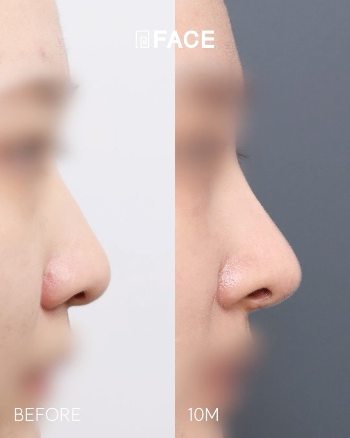 face_ps 게시물 이미지: 맞춤형 코 보형물 쏘핏은 키닥터 페이스 성형외과에서 함께하세요!

#페이스성형외과...