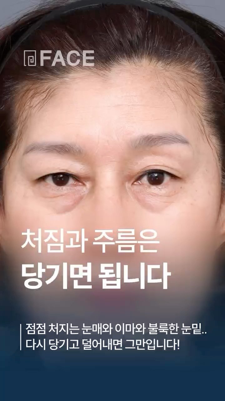 face_ps 게시물 이미지: 점점 처지는 눈매와 이마, 그리고 불룩한 눈밑..
다시 당기고 덜어내면...