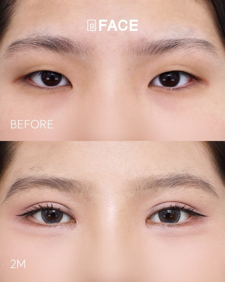 face_ps 게시물 이미지: 내려앉고 답답한 눈매는 절개+앞트임으로 페이스와 함께 해결해보세요!

#대전성형외과...