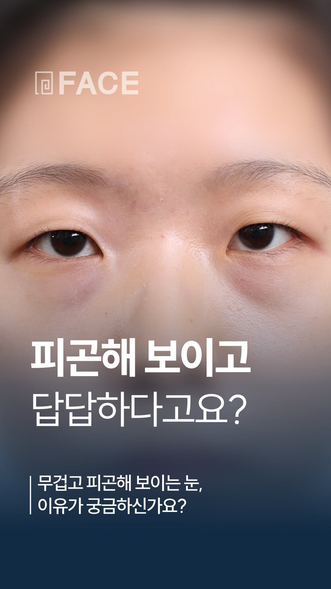 face_ps 게시물 이미지: 피곤해 보이는 눈 밑의 비밀🤔| 대전페이스성형외과

무겁고 피곤해 보이는 눈,...