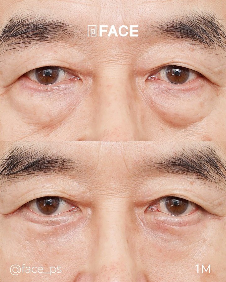 face_ps 게시물 이미지: 피곤한 눈밑의 무거운 짐을 말끔하게 지워드립니다☺️
-> 중년...