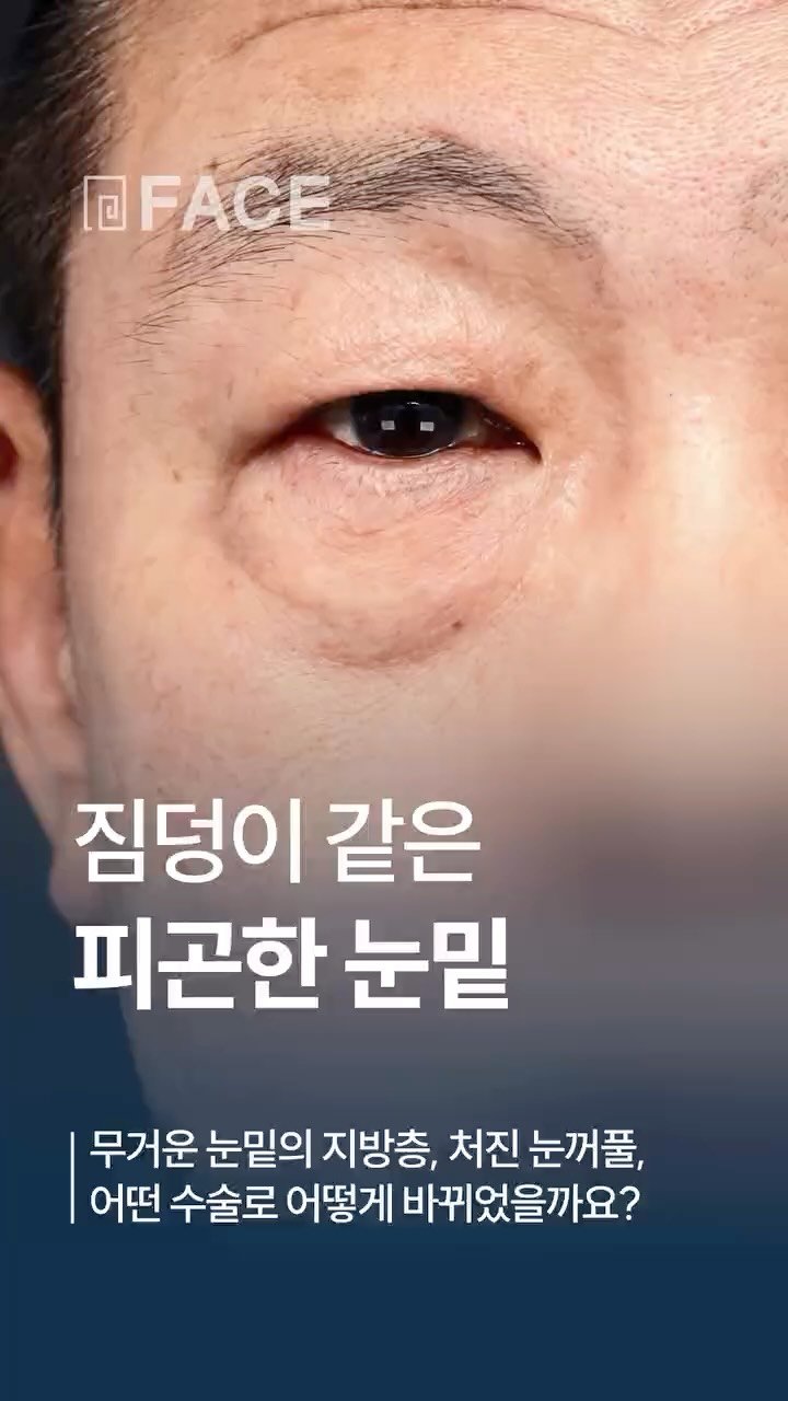 face_ps 게시물 이미지: 페이스와 함께 시간을 돌려보시겠어요?

#하안검 #대전눈성형 #대전성형외과...