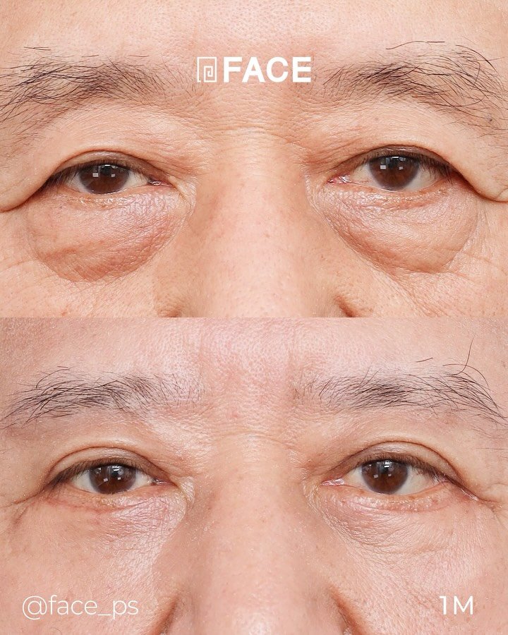 face_ps 게시물 이미지: 처짐도 복구하고 힘찬 눈빛으로 돌아가고 싶으시다면?😊
-> 대전 페이스 성형외과에서...