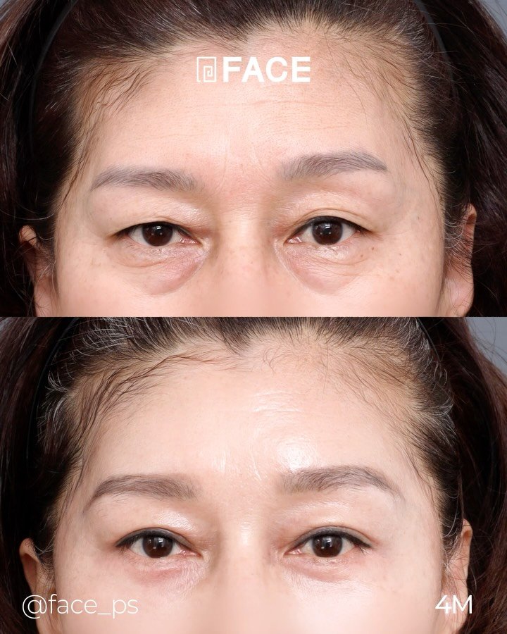 face_ps 게시물 이미지: 노화는 피할 수 없지만 처짐은 완화할 수 있습니다!☺️
->...