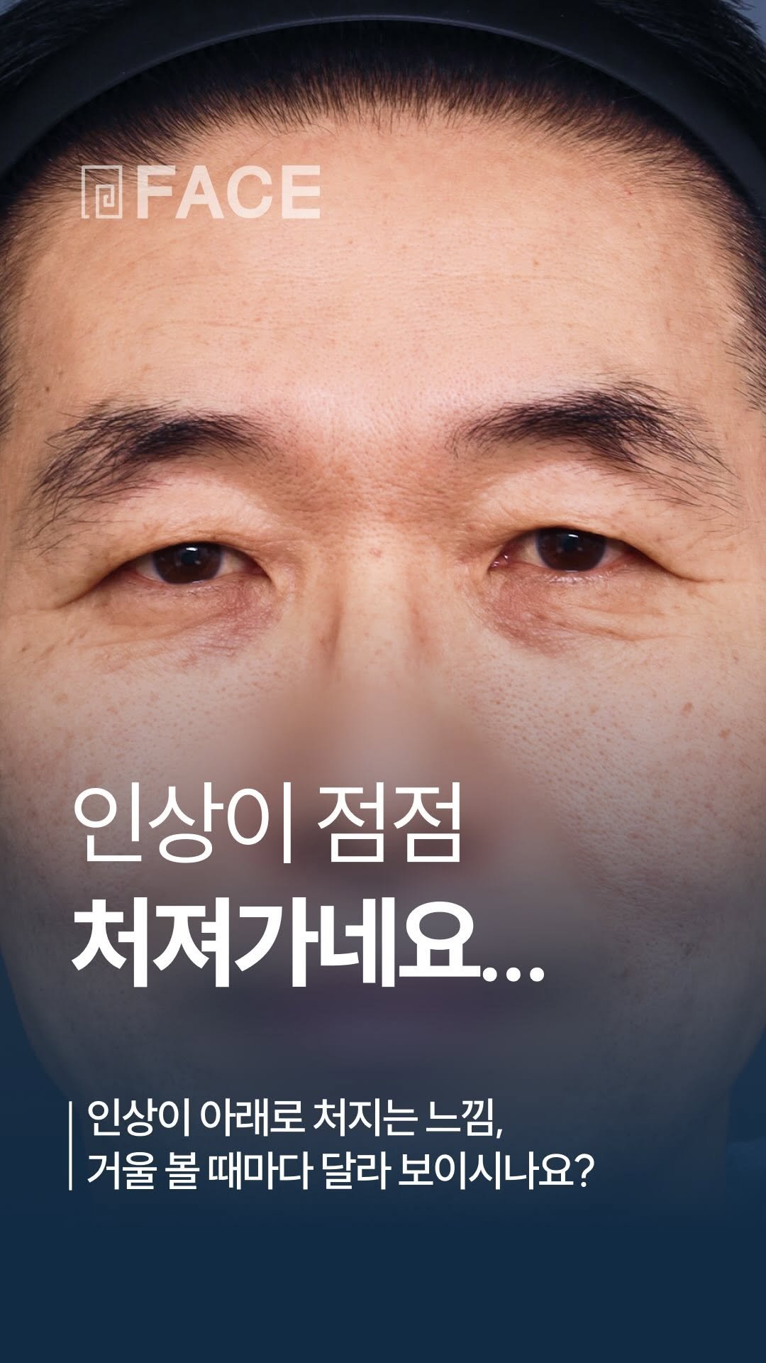 face_ps 게시물 이미지: 점점 처져가는 인상을 위해선?🤔 | 대전페이스성형외과

인상이 아래로 처지는...