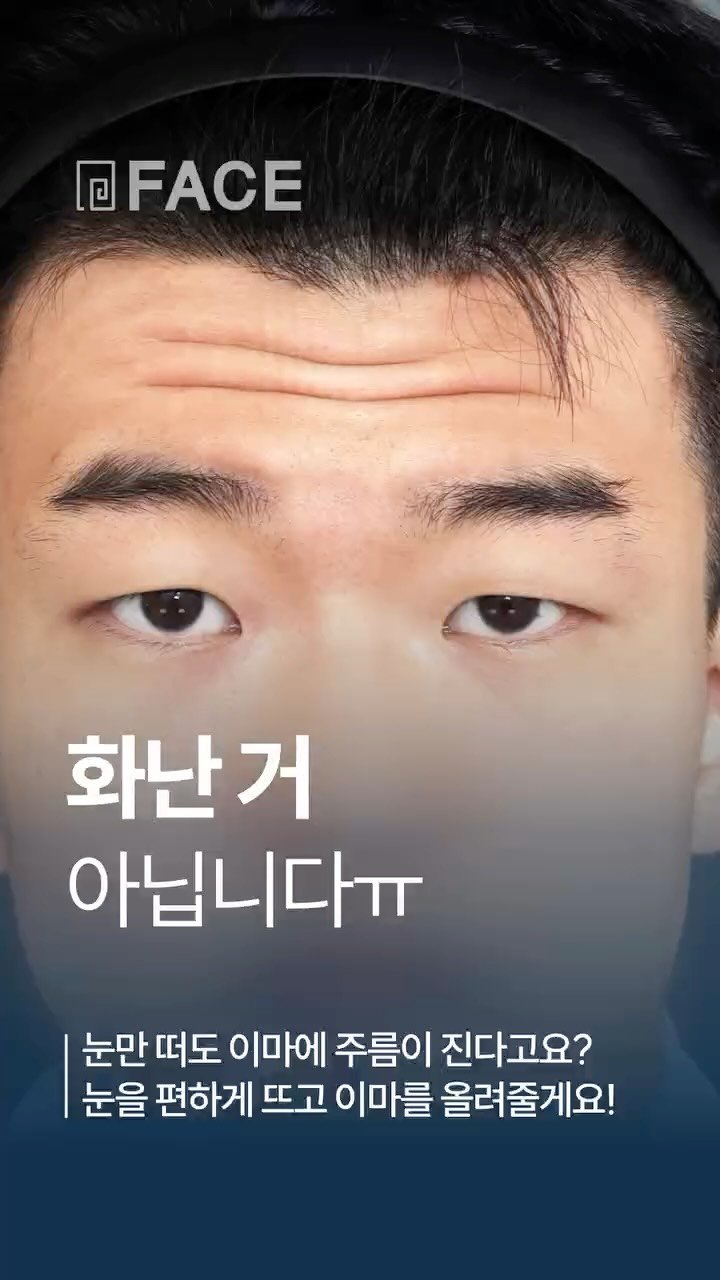 face_ps 게시물 이미지: 이마주름이 고민이시라고요?

눈을 뜨기만 해도 생기는 이마주름, 젊은 나이의...