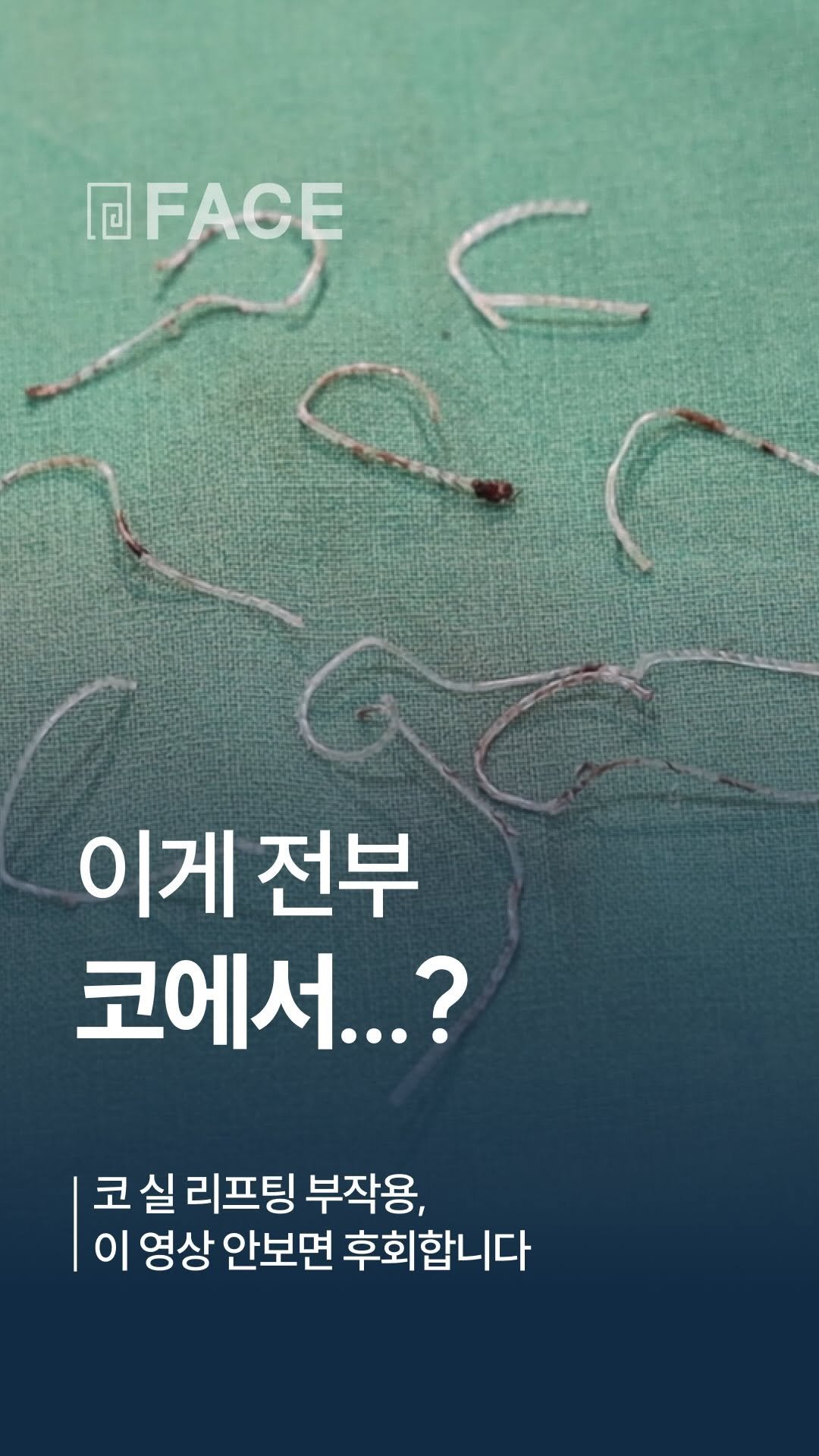 face_ps 게시물 이미지: 코 실 리프팅 부작용, 이 영상 안 보면 후회합니다 ⚠️ | 대전페이스...