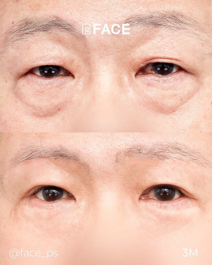 face_ps 게시물 이미지: 페이스와 함께 흐릿하고 무거운 눈에서 더 또렷하고 가벼운 눈으로! -> 하안검,...
