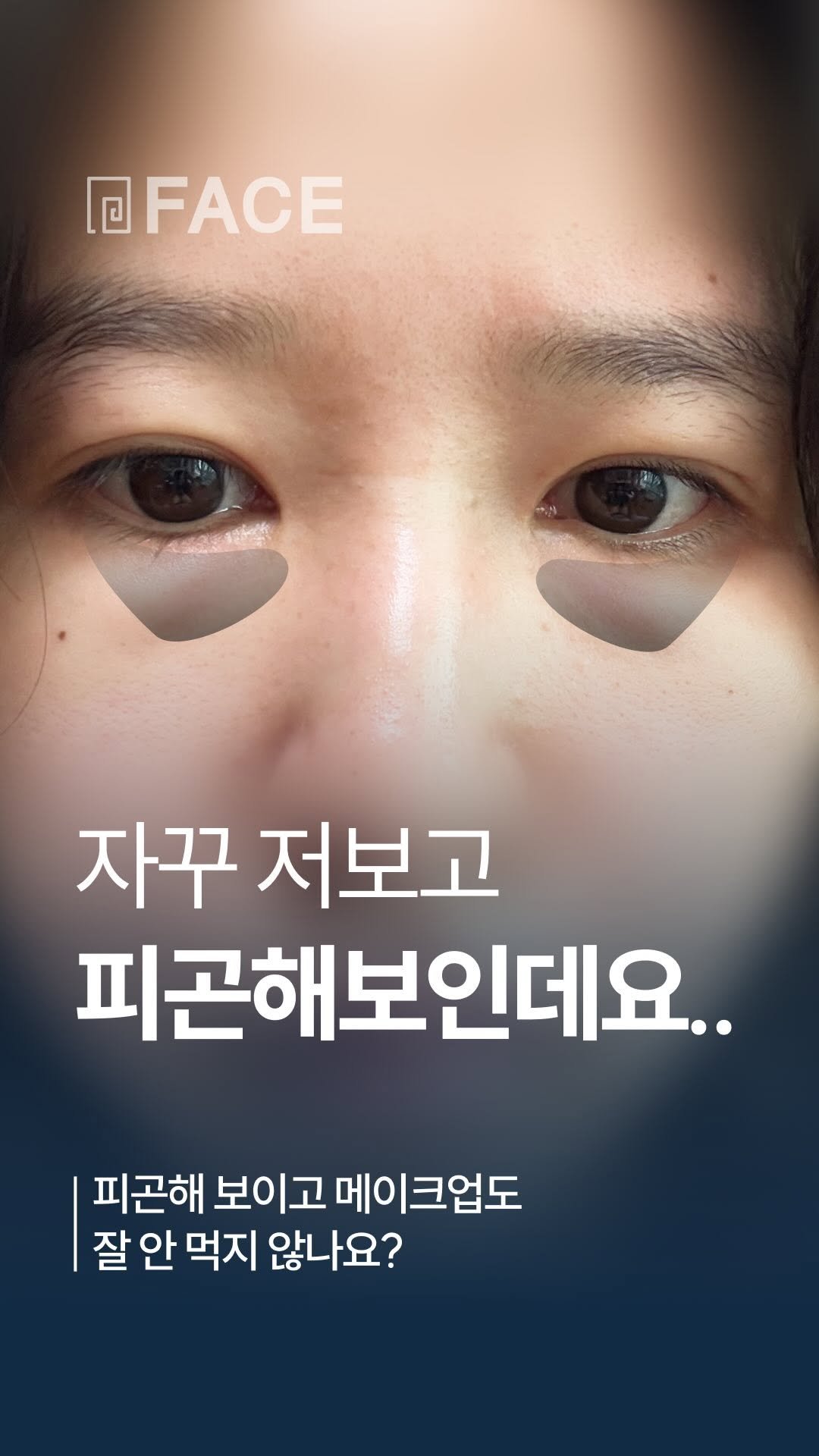 face_ps 게시물 이미지: 자꾸 피곤해보이는 눈...🤔 | 대전페이스성형외과

아래로 내려와 보이는...