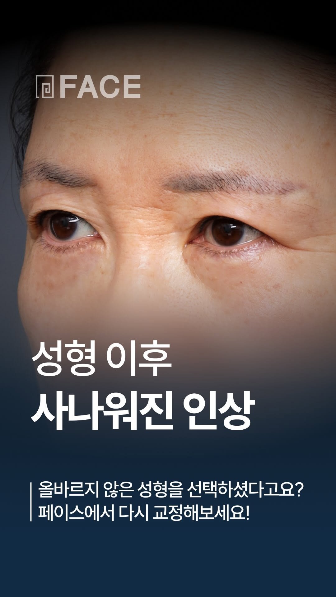 face_ps 게시물 이미지: 눈썹밑절제술 이후
강해 보이고 날카로워진 인상으로 고민하셨던 60대 여성 환자분의...