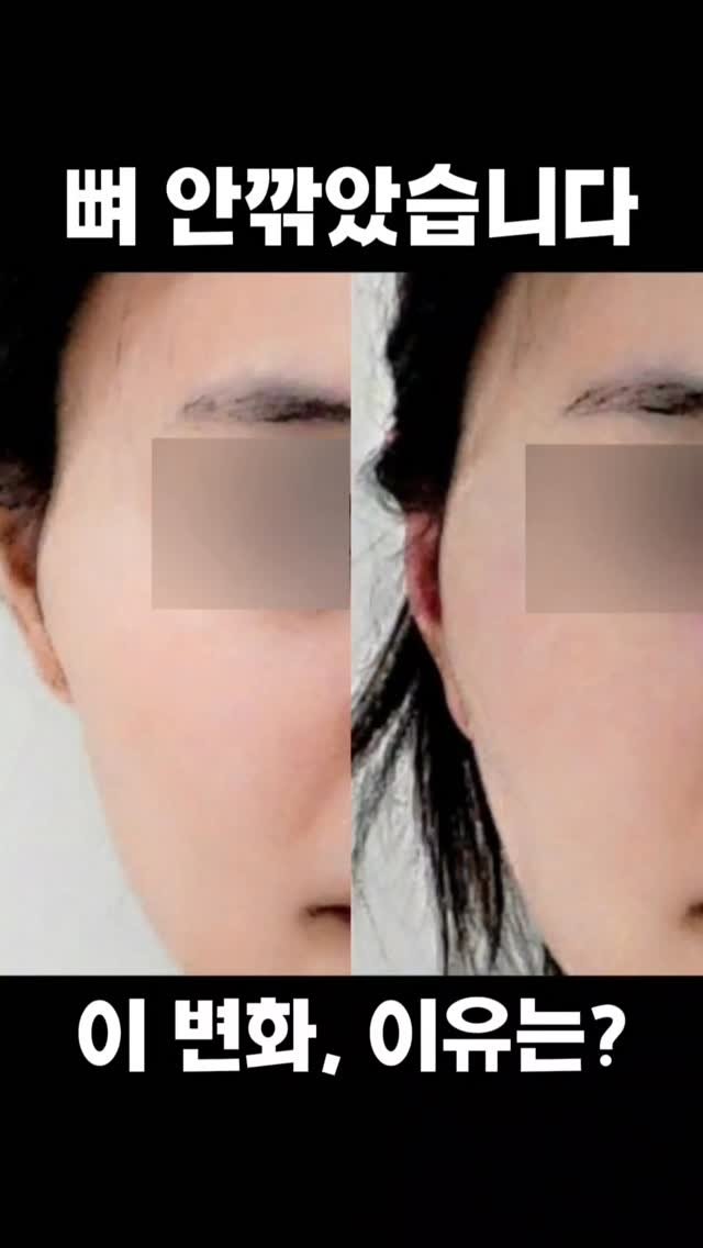 faceteacher_juunq 게시물 이미지: 뼈를 깎아야만 광대가 작아질까요?
그렇지 않습니다

광대가 커 보이는 이유는 단순히...