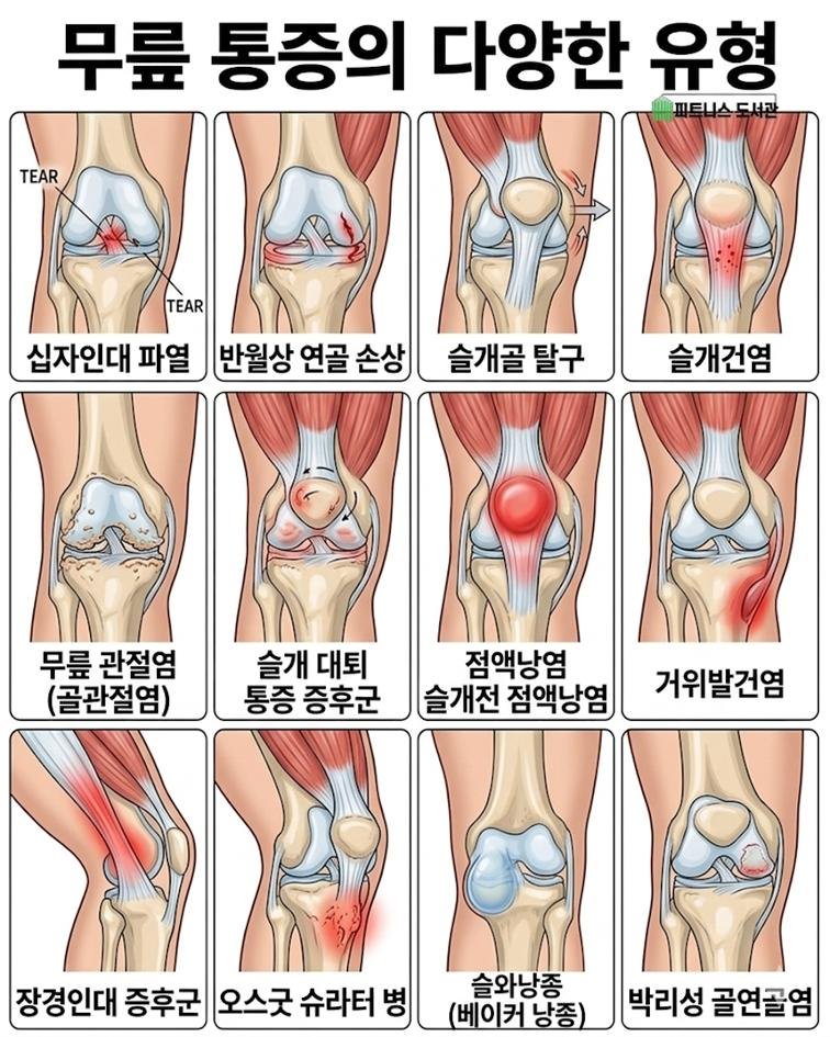 fitness_library_ 게시물 이미지: 🧠 무릎 통증, 이렇게 이해하면 끝

✅ 1. 십자인대 파열
→ 방향 전환하다...
