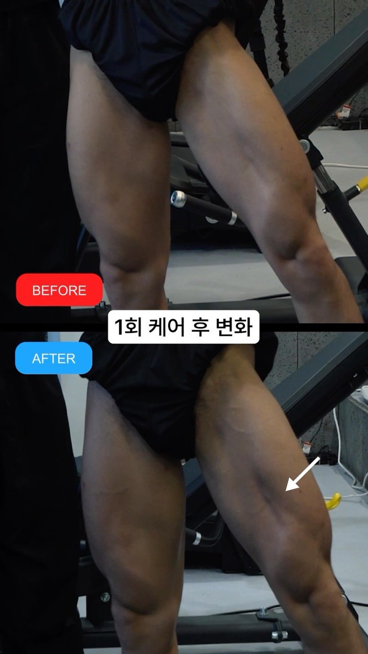 fixyrbody 게시물 이미지: 다음주 대회 출전하시는 회원님
1회 컨디셔닝 후 변화입니다.

대퇴 전면부의...