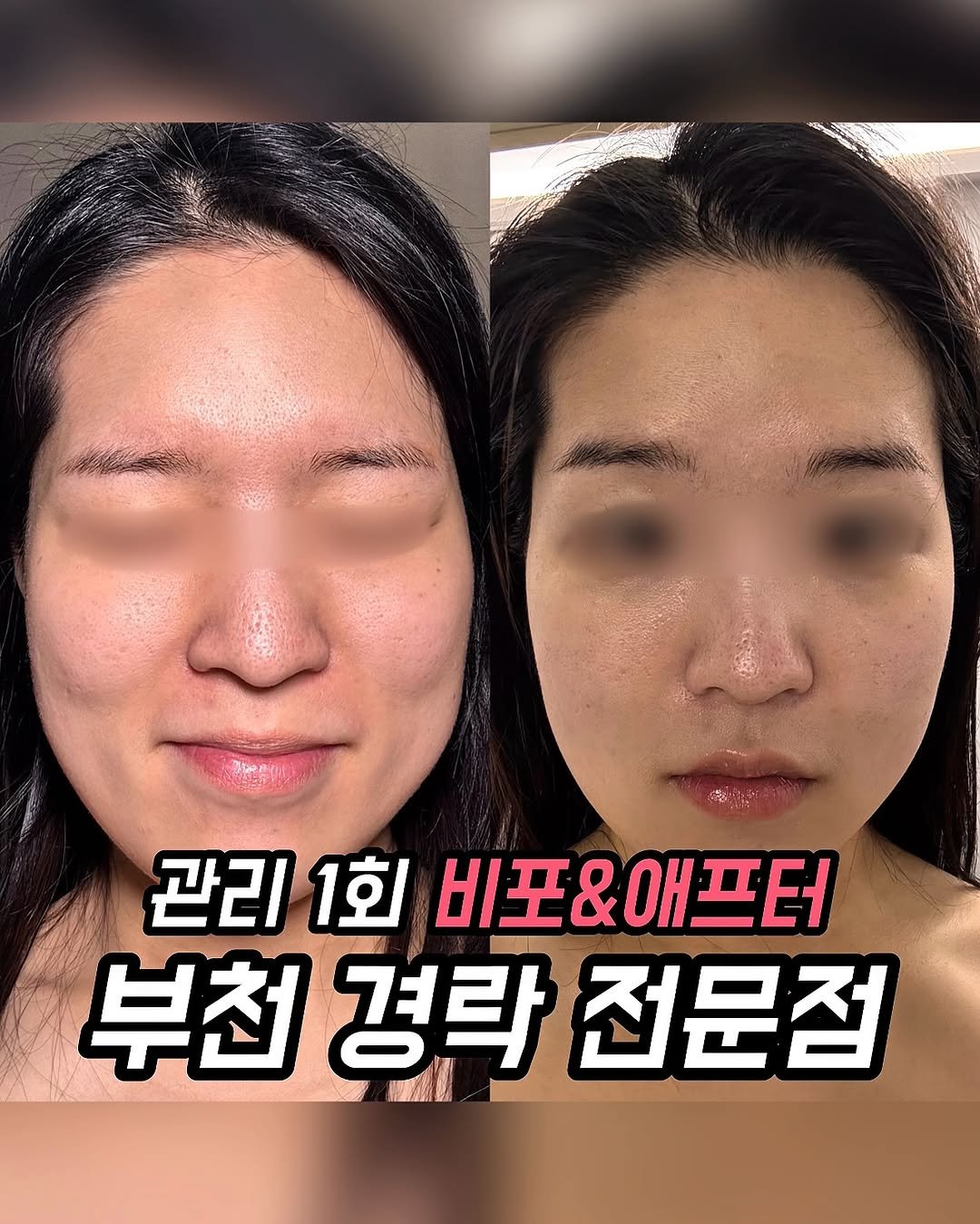 Photo shared by 푸드먹자 [ 부천맛집 | 서울맛집 | 요즘핫플 ] on February 01, 2026 tagging @jr_therapy. May be an image of text that says '관리1회비포&애프터 관리1회 관리 1회 비포&애프터 부천경락전문점 부천 경락 전문점'.