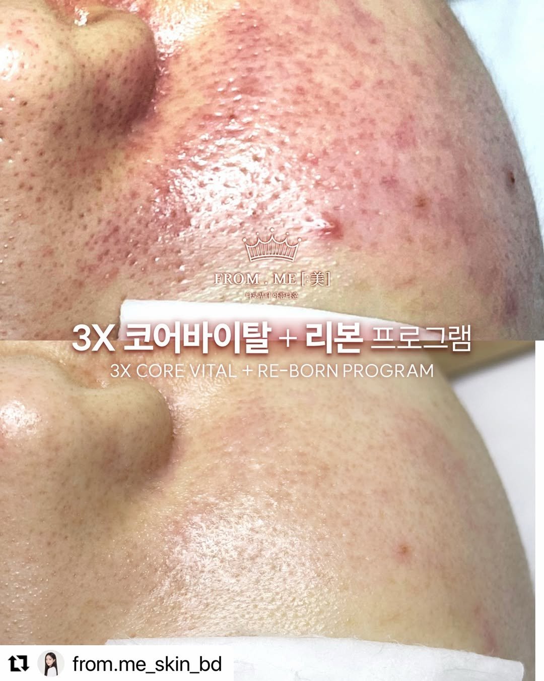 from.me_skin 게시물 이미지: #Repost @from.me_skin_bd with...