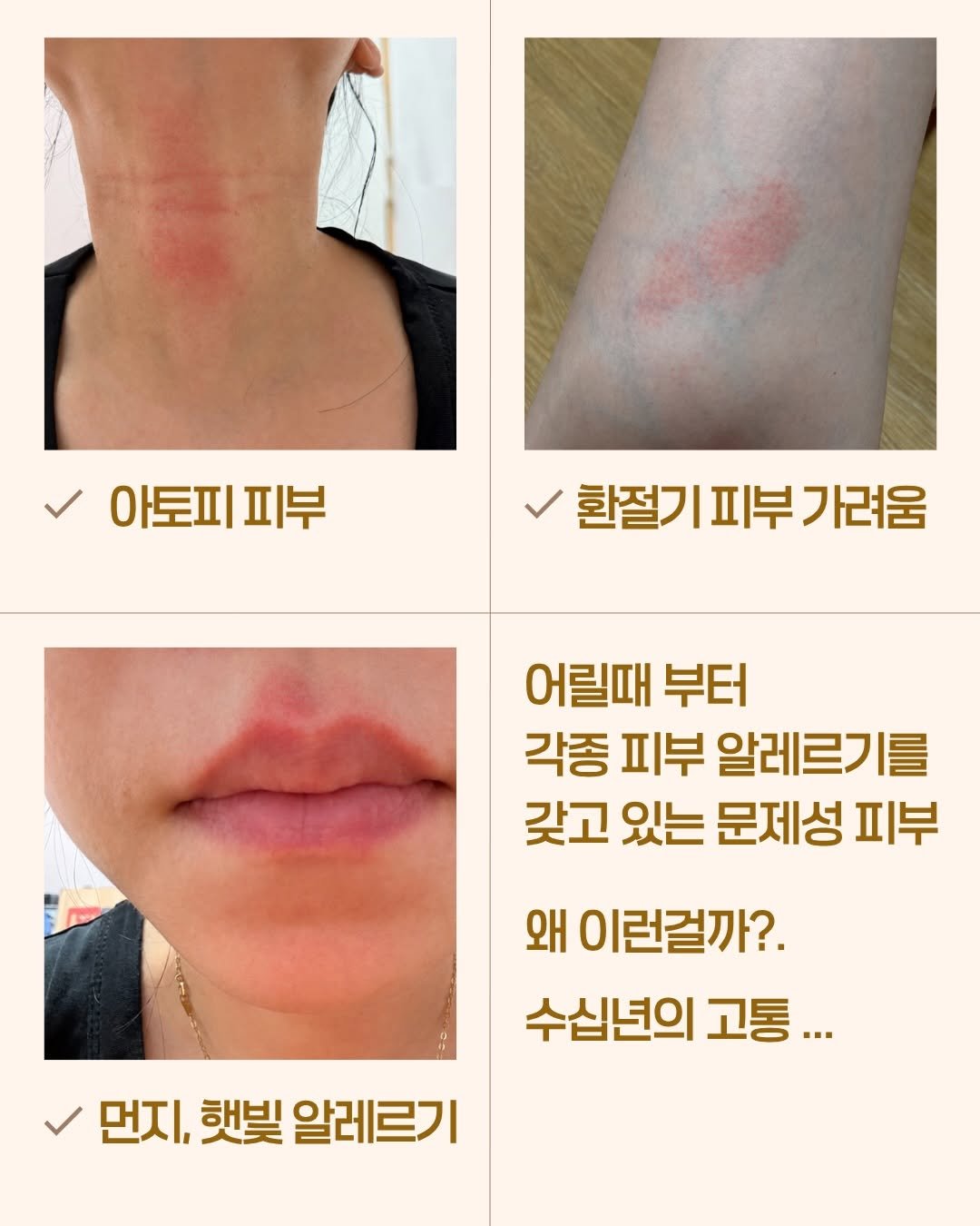 from_wellness 게시물 이미지: 제가 어릴 때는 아토피라는 개념 자체가 없었어요.
초등학교 들어가기 전부터
온몸에...
