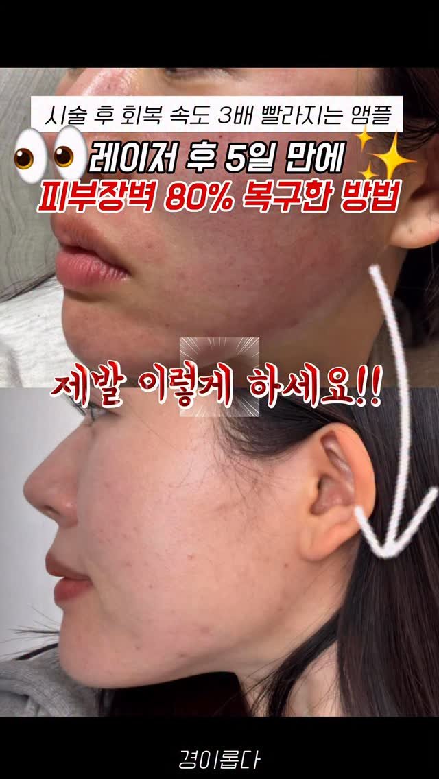 g.yeong__2 게시물 이미지: 댓글이벤트‼️시술 후 이거 안하면 손해에요 

시술 받고 “이제 끝!“ 하고...