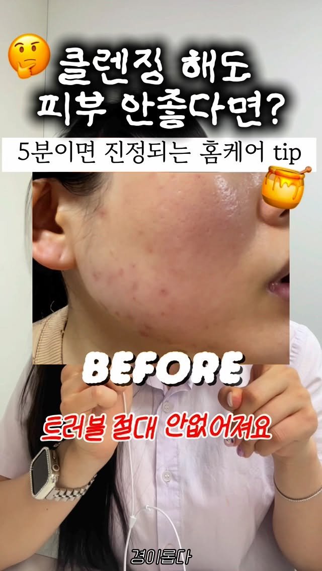 g.yeong__2 게시물 이미지: (광고) 집에서 끝내는 트러블관리 루틴‼️
피부과 아무리 다녀도 트러블이 자꾸...