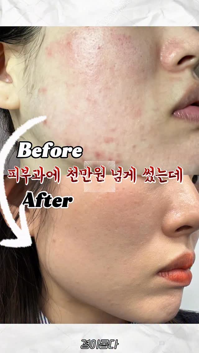 g.yeong__2 게시물 이미지: 댓글이벤트‼️ 30만원 넘게 아끼는 꿀tip ㄹㅇ..

어렸을 때부터 트러블 나보신...