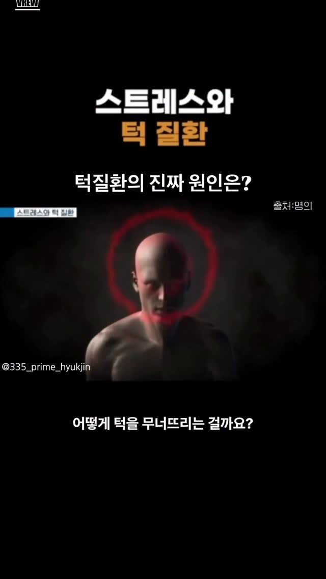 gaengstar1 게시물 이미지: 턱관절과 스트레스의 
관계성을 잘 보여주는 영상이네요

#턱관절 #턱질환 #턱 #스트레스