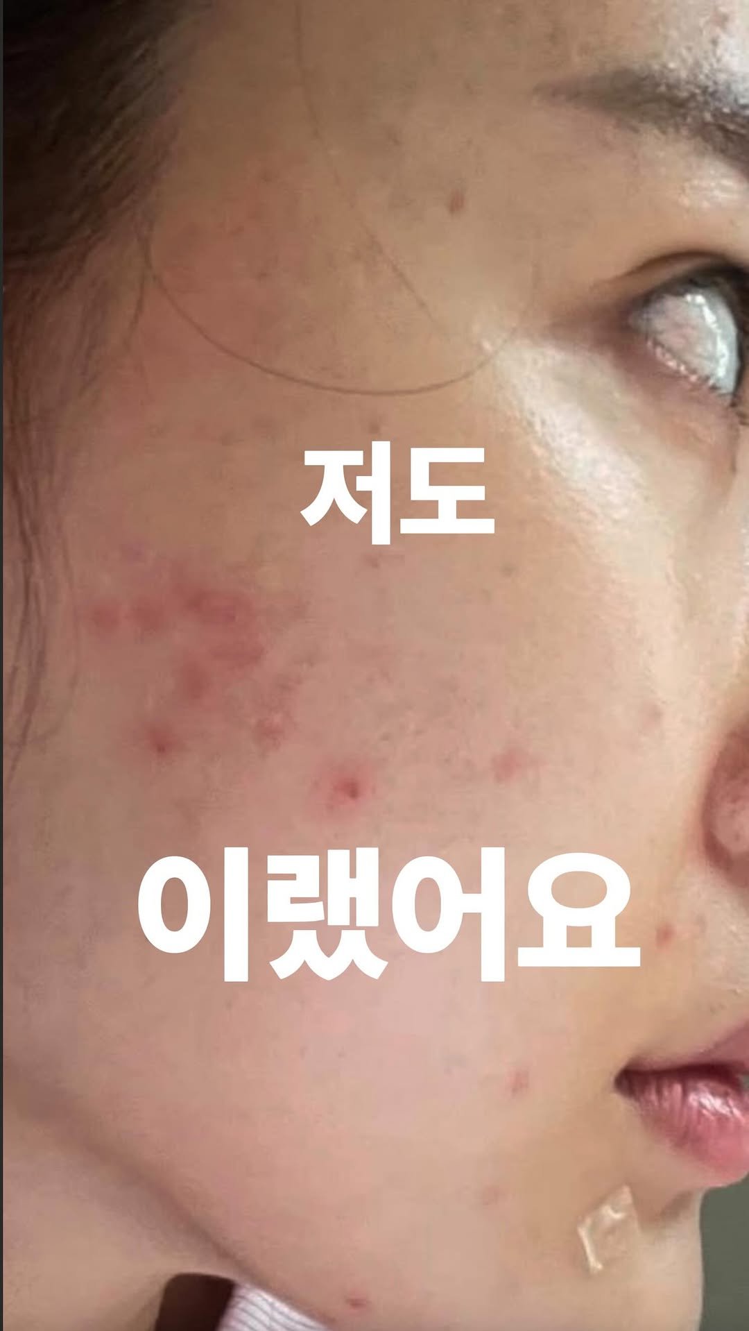 genial_spoon 게시물 이미지: 여드름 곰보 피부도 이것만 지키면 꿀피부 쌉가능🖤
‼️아래 확인해...