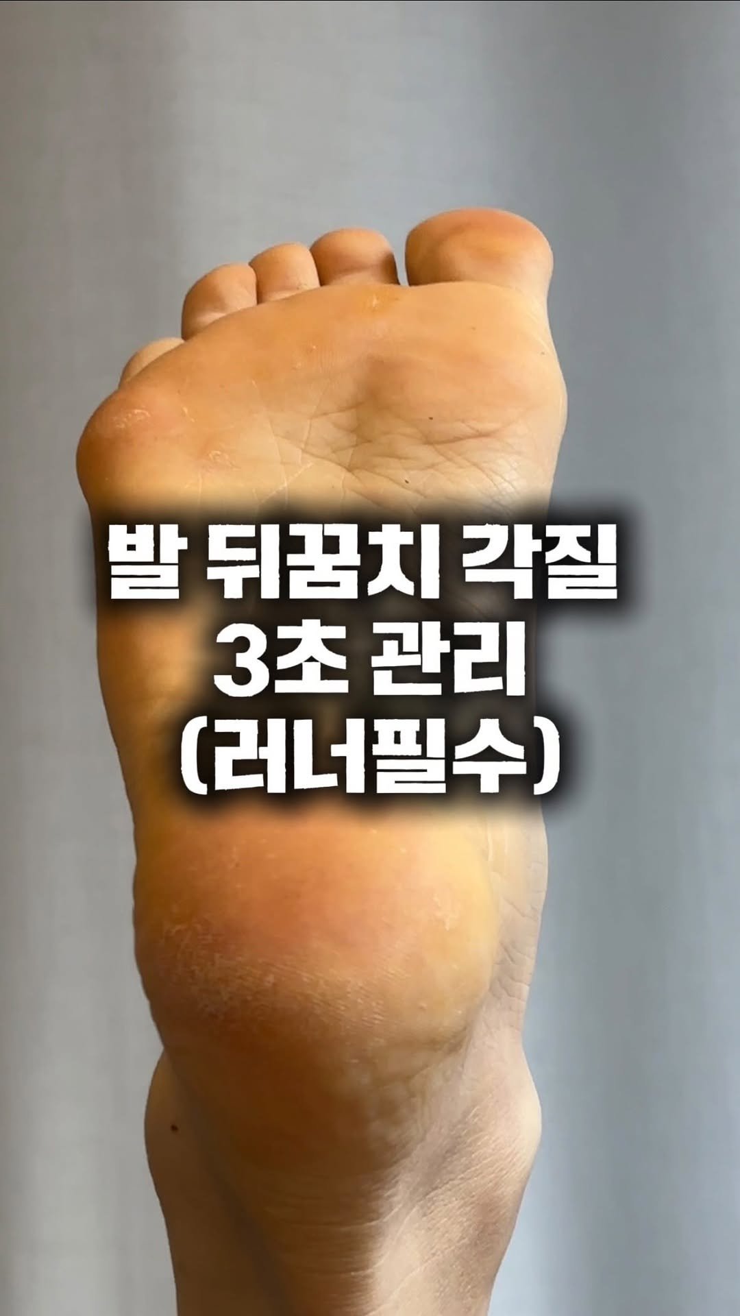 giverun369 게시물 이미지: 여름철 발 뒤꿈치 각질 그대로 두면 정말 확 깨는거 아시죠? 🥲 

방치하면 계속...
