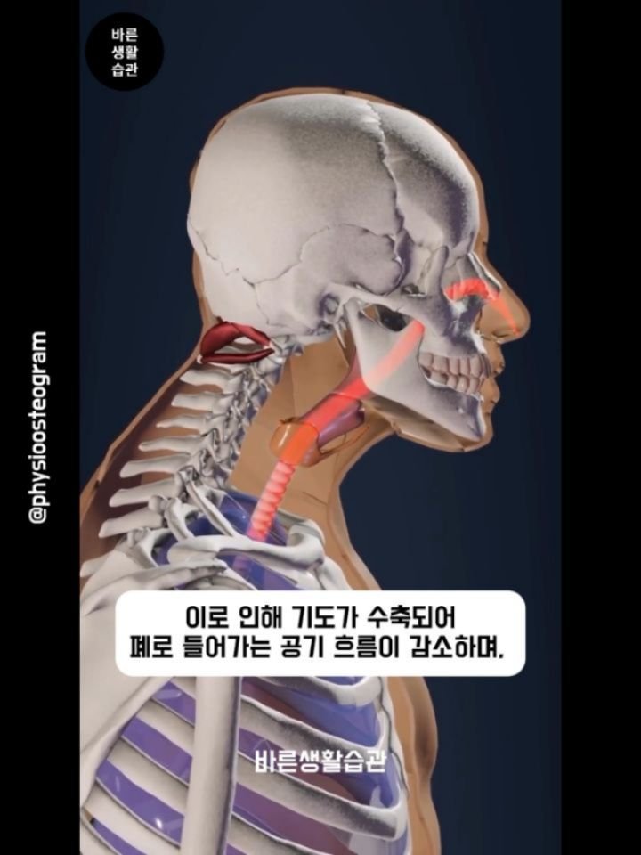 good_lifestyle_habit 게시물 이미지: 거북목 자세는 호흡에 문제를 일으킵니다.
✅ Forward head posture...
