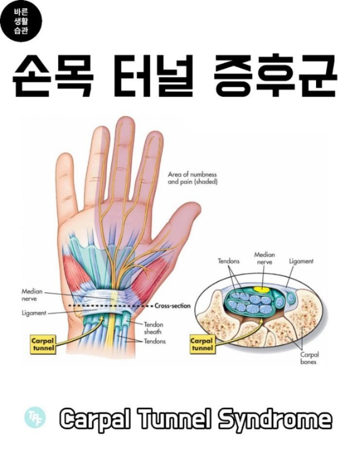 good_lifestyle_habit 게시물 이미지: 손목터널증후군 (Carpal Tunnel Syndrome) — 실제로 도움이 되는...