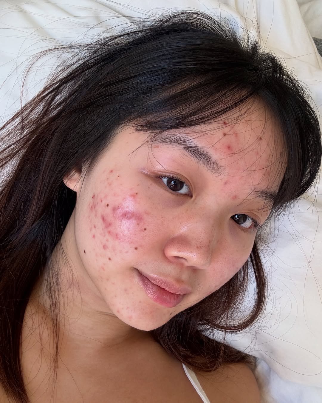 gracemay_official 게시물 이미지: real skin has textures 🤍

#acne #hormonalacne...