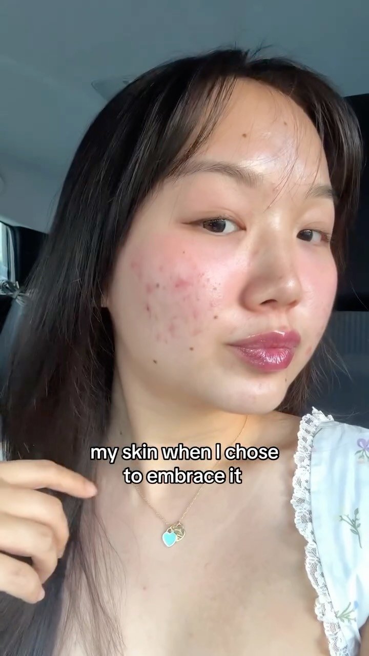 gracemay_official 게시물 이미지: Acne can make you feel like you have to hide....