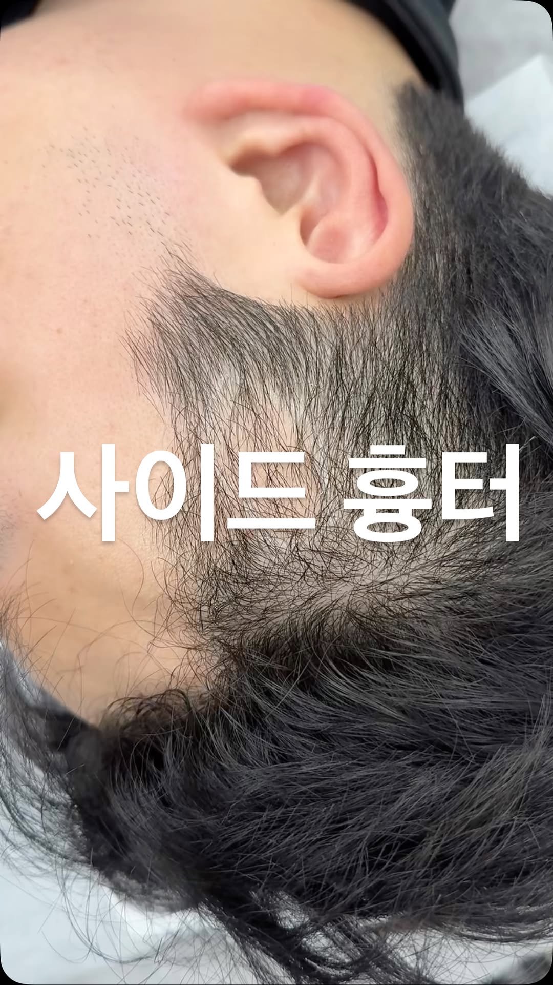 graycity_nix 게시물 이미지: 좁은 면적이지만 신경쓰이는 곳.

흉터로 인해 두피가 비쳐 보여서 신경쓰일...
