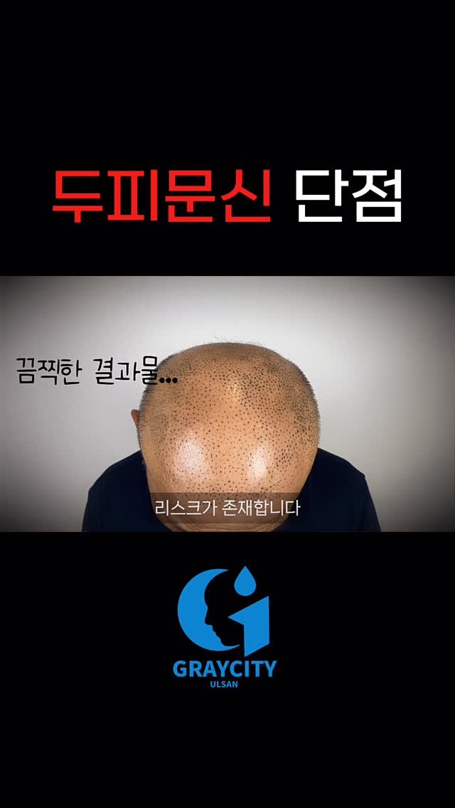 graycity_nix 게시물 이미지: 🚨 두피문신 전 반드시 알아야 할 치명적 단점 2가지 🚨

.
.
.

1️⃣...