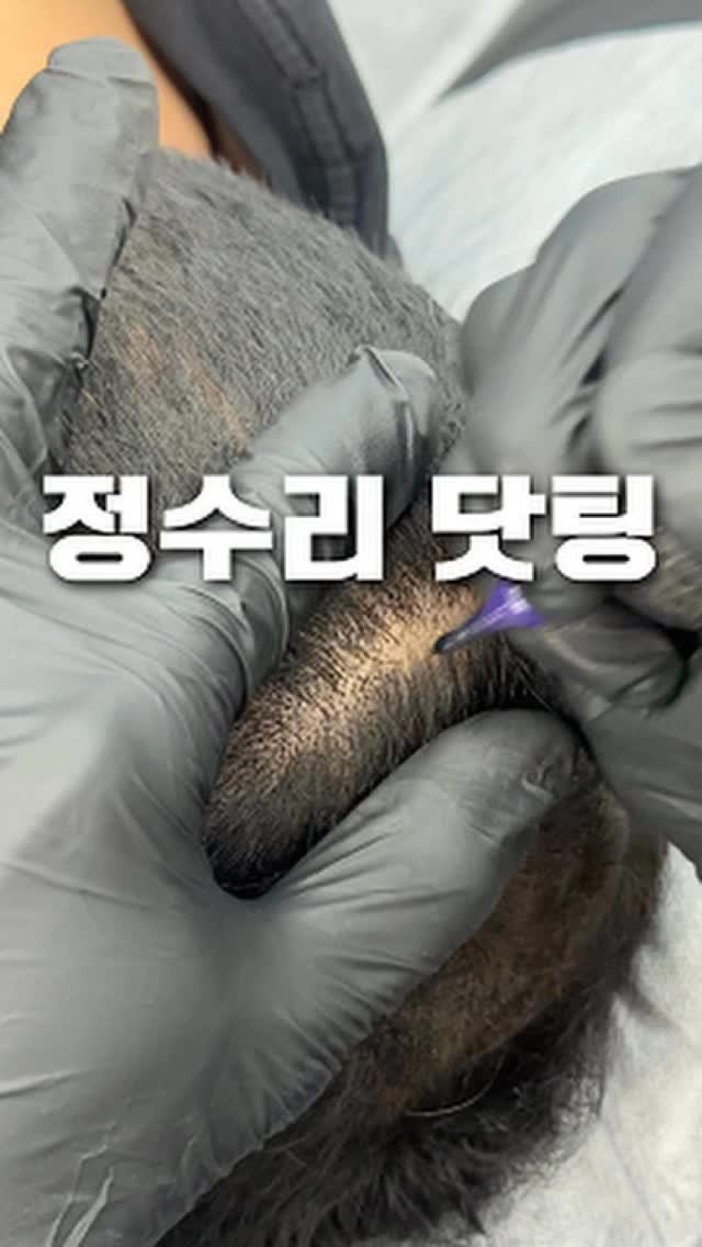 graycity_nix 게시물 이미지: 정수리 두피문신은 어떻게 풍성해 보일까요?
.
.

탈모가 진행함에 따라 두피가...