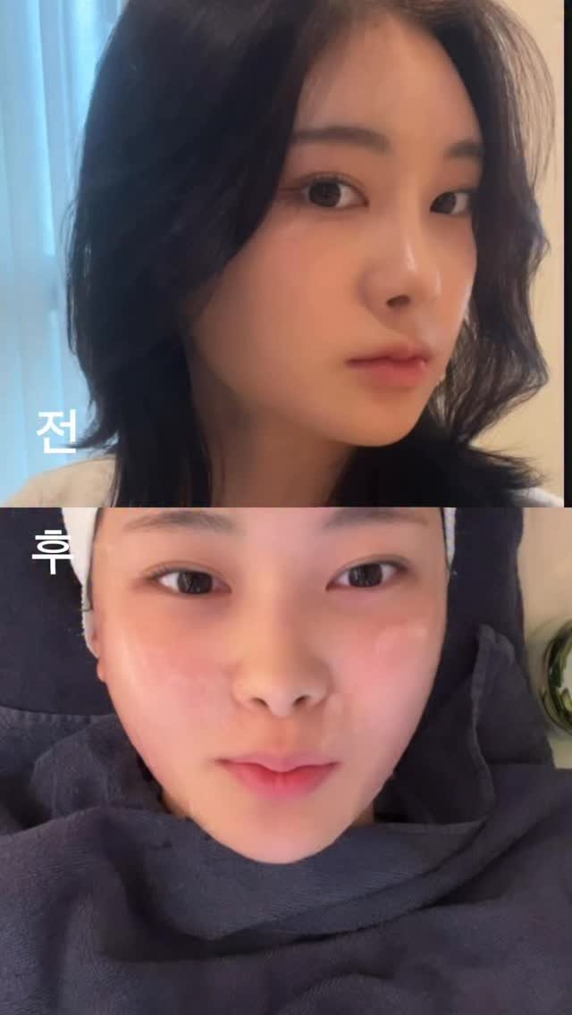 h.young_life 게시물 이미지: 성형보다 어쩌면 문의가 더 많았을지 모르는 얼굴형 !! 
드디어 가지고 왔어요...