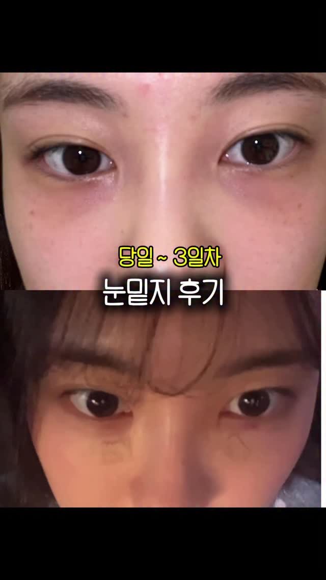 h.young_life 게시물 이미지: 눈밑지 후기 드뎌 끓의옵 ~~ 💗
당일부터 ~3일차까지 모습임니당 
효과 좋은데...