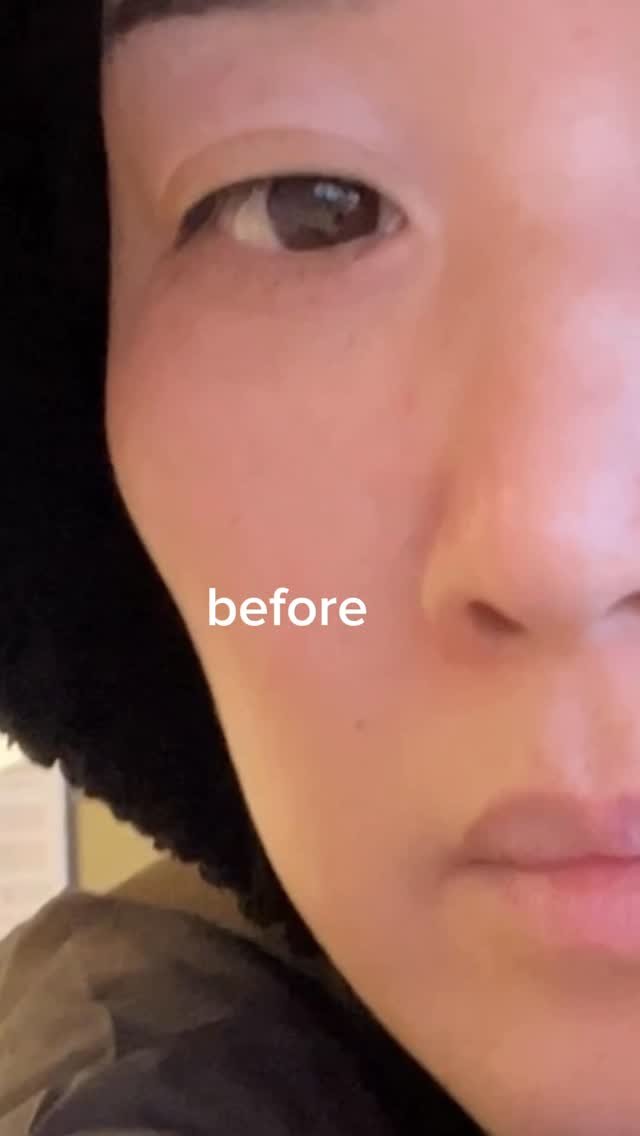 h.young_life 게시물 이미지: 시술 받고 집 갔는데
엄마가 제 얼굴을 보더니
“뭐했어 ? 티 안나게 예뻐졌는데...