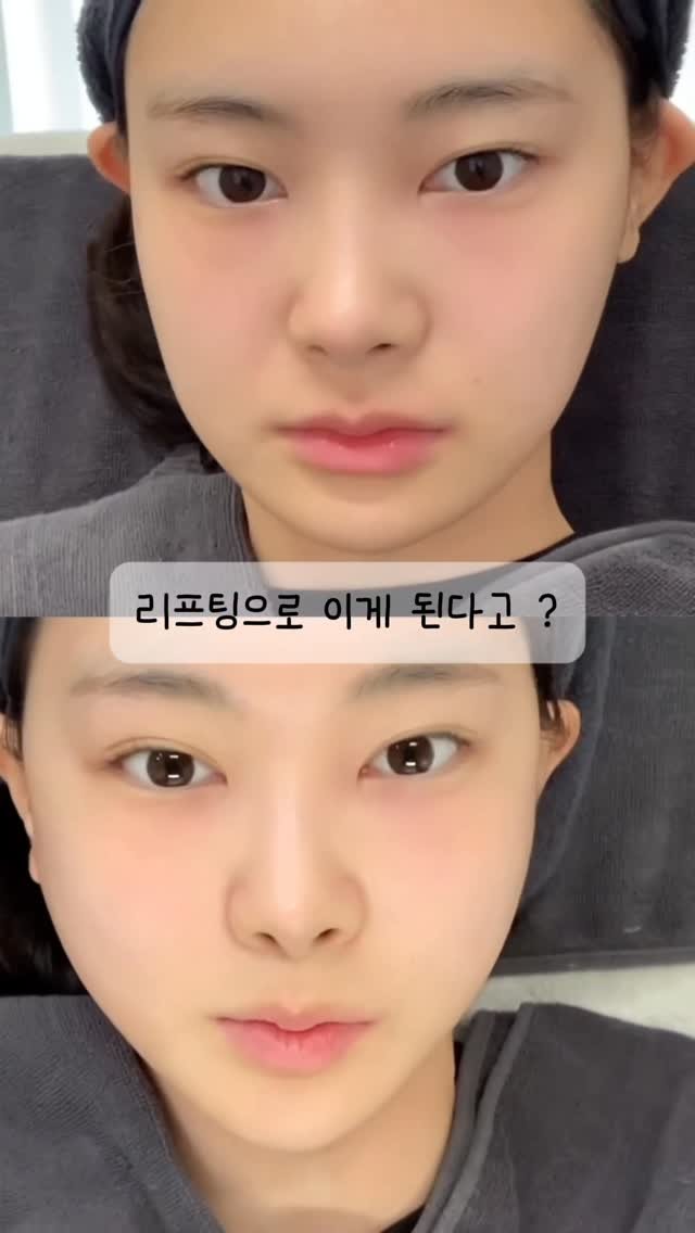 h.young_life 게시물 이미지: 🔥 미친 리프팅 후기 + 이벤트 🔥

여러분 저 이번에 진짜 미친 .. 리프팅...