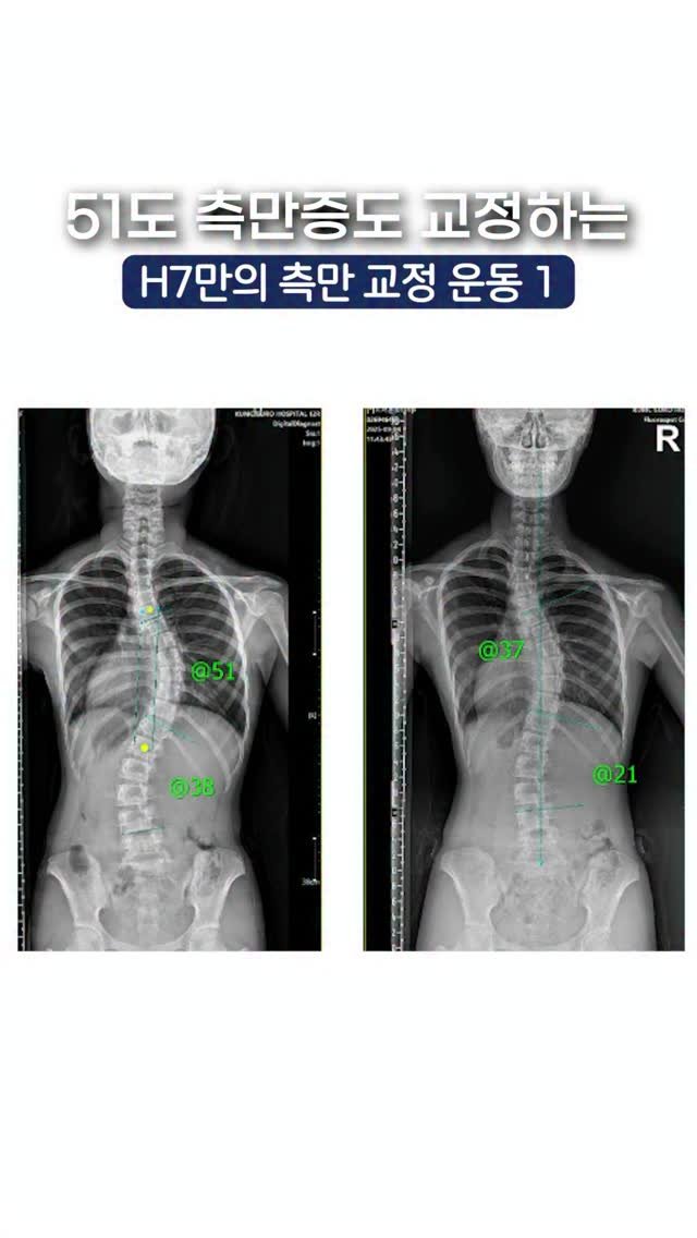 h7_ceo 게시물 이미지: 51도 측만증,
과연 교정이 될까요? 🤔

사실 그건
케이스마다 다를 수...